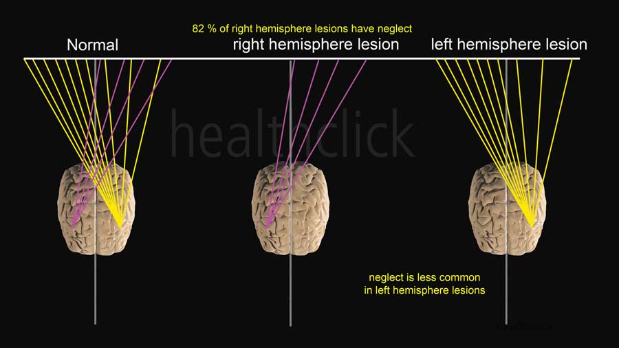 erapy Stroke Rehab Course