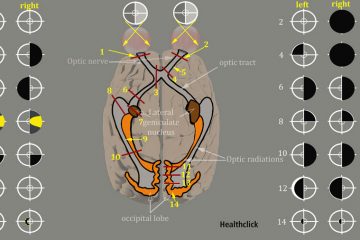 Stroke Rehab and Visual Impairment Continuing Education