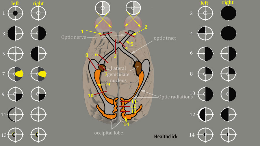 Stroke Rehab and Visual Impairment Continuing Education